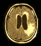 Fig. 1: Axial T1-Gd-enhanced MRI shows meningeal involvement, mesencephalic mass localized at the left parieto-occipital part and dilated ventricles.