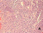 Fig. 2A: Intracerebral metastasis of malignant melanoma. Nests of epithelioid tumor cells with large, hyperchromatic nuclei, hematoxylin-eosin staining.